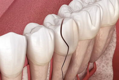 img-Chipped,-Cracked,-Or-Fractured-Teeth