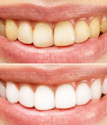 img-How-Do-Teeth-Whitening-Products