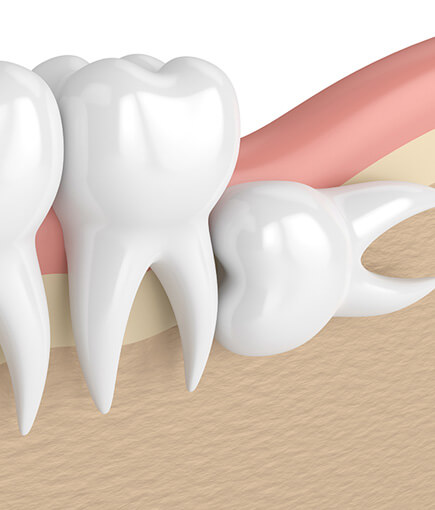 img-How-Much-Does-A-Tooth-Extraction-Cost