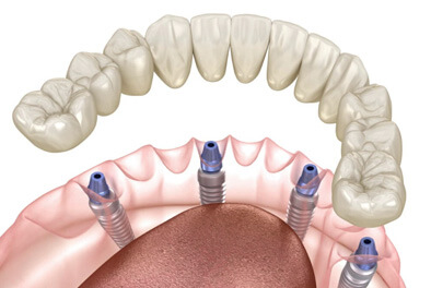 img-Implant-Supported-Denture