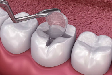 img-Missing-Or-Damaged-Filling