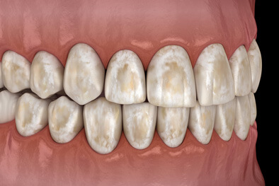 img-Tooth-Damage-Associated-With-Bruxism