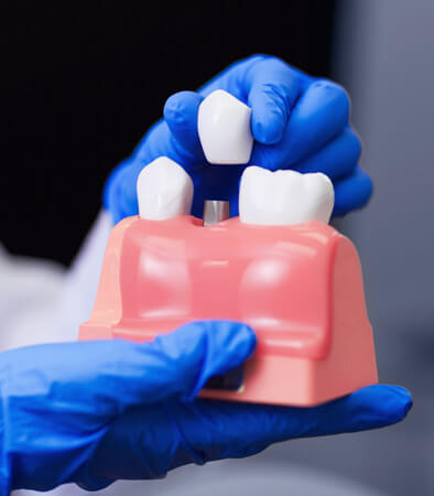 img-What-Are-Tooth-Bridges-And-Tooth-Crowns