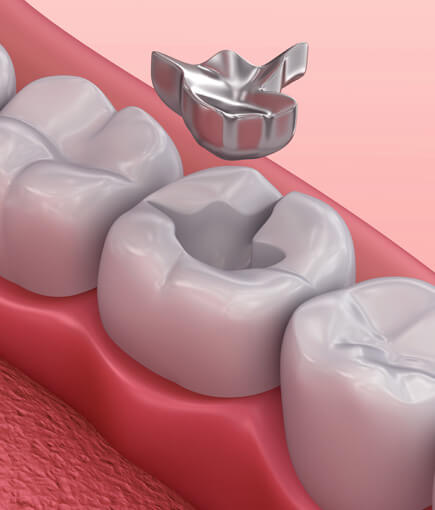 img-What-Are-Tooth-Fillings